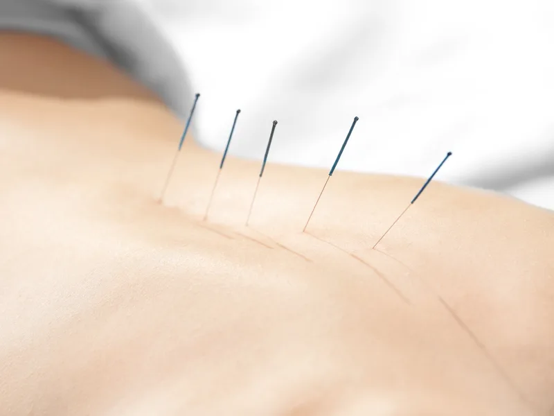 Acupuncture at Thornapple River Chiropractic in Grand Rapids