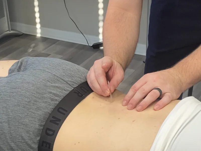 How Dry Needling works at Thornapple River Chiropractic