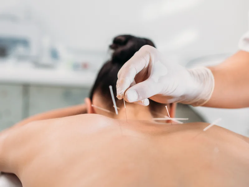 Dry Needling at Thornapple River Chiropractic in Grand Rapids